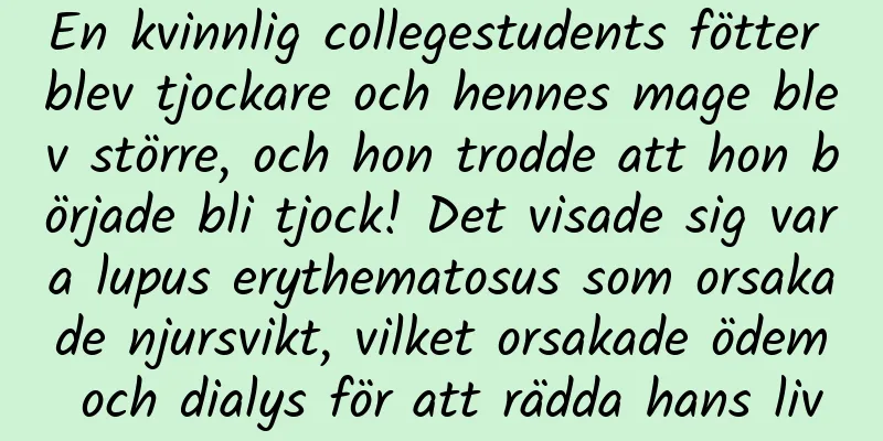 En kvinnlig collegestudents fötter blev tjockare och hennes mage blev större, och hon trodde att hon började bli tjock! Det visade sig vara lupus erythematosus som orsakade njursvikt, vilket orsakade ödem och dialys för att rädda hans liv